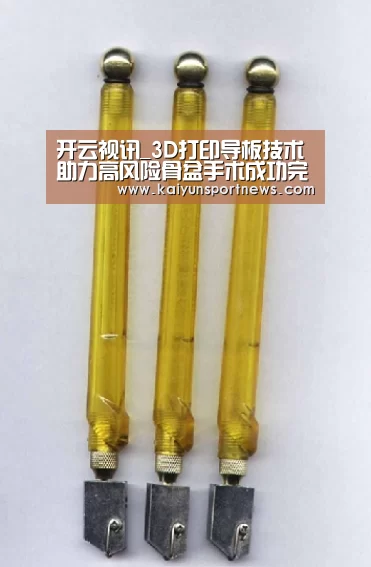 开云视讯_3D打印导板技术助力高风险骨盆手术成功完成(图1) 开云品牌